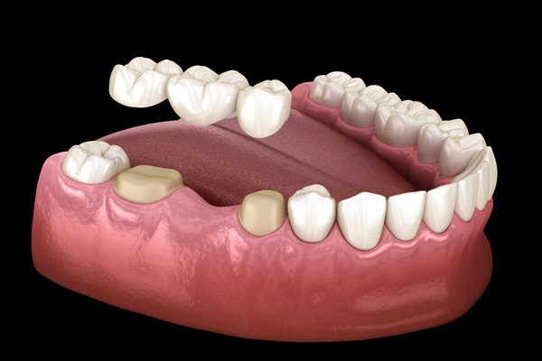 Pros And Cons Of Dental Bridges