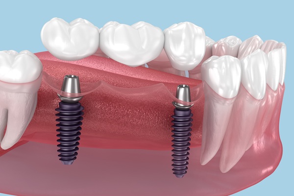 Dental Bridges, Explained: Types, Benefits, And Longevity