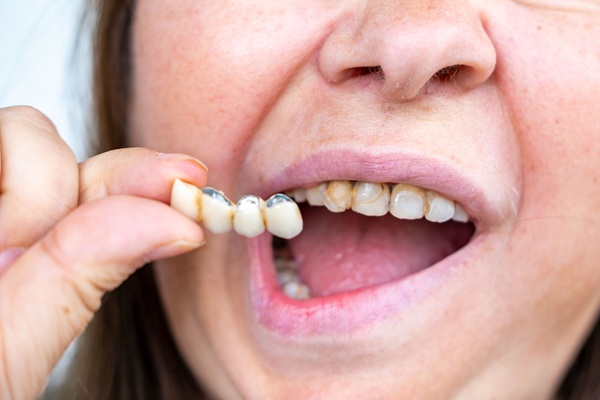 When Should You Choose A Dental Bridge Over An Implant?