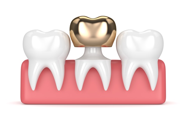 Important Facts To Know About Dental Crowns