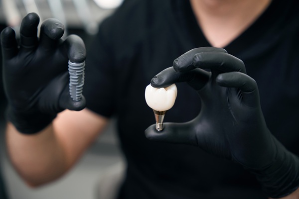 What To Expect During A Dental Implant Procedure: Step By Step