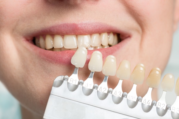 Signs Your Dental Veneers Need Replacing